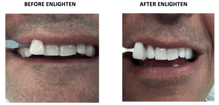 before and after enlighten teeth whitening in London