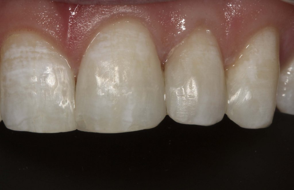 dental treatment real case result