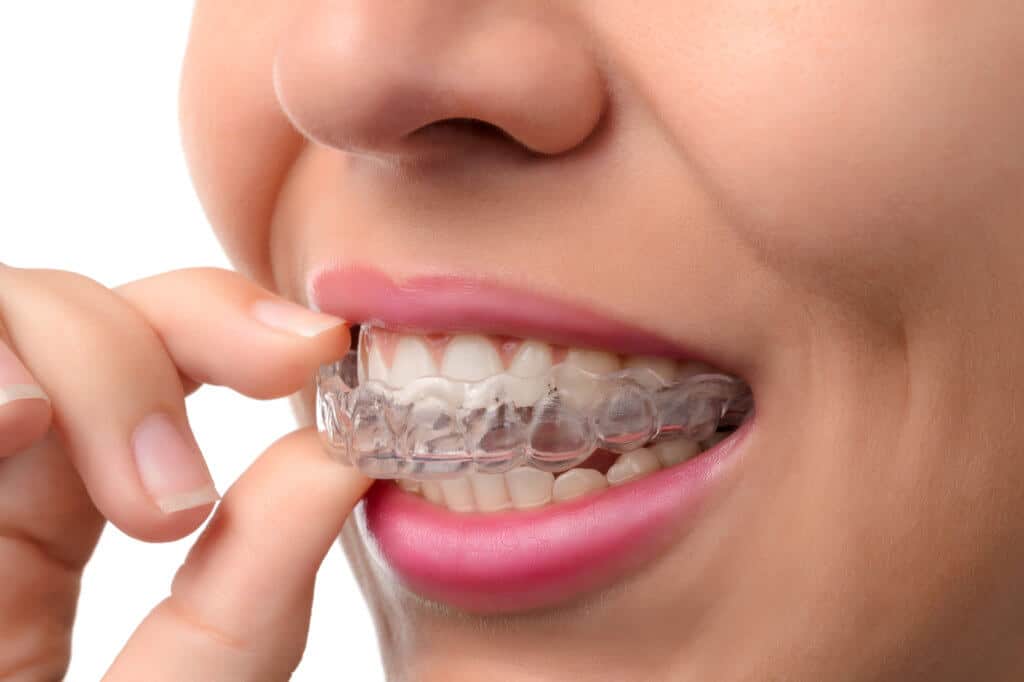 how does invisalign works