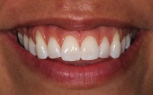 professional whitening after