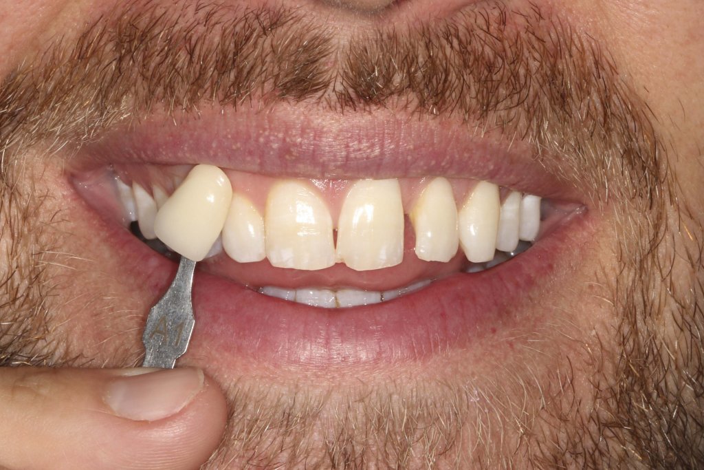 dental treatment real case result