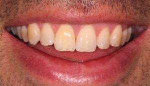 professional whitening after