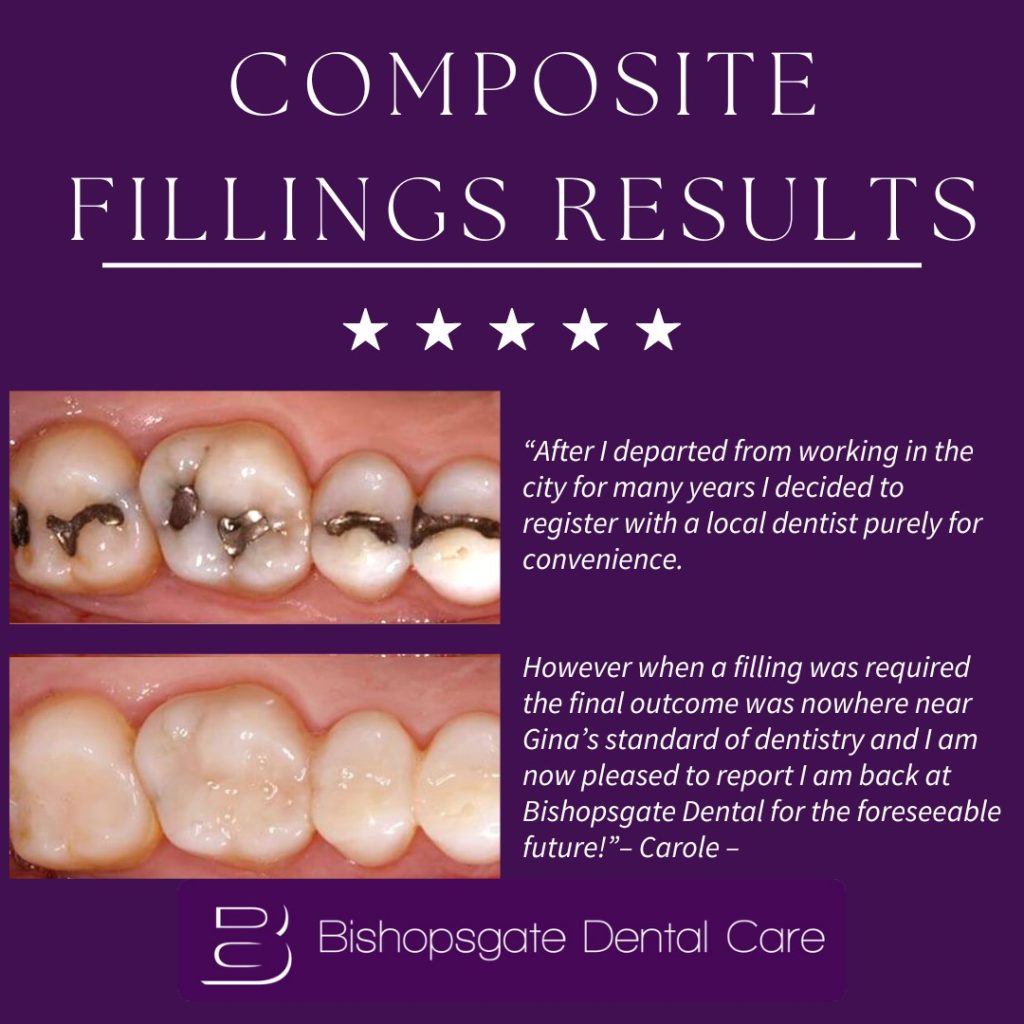 Composite Filling Client Results